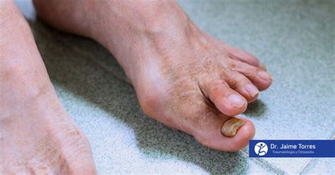 Esquema de las deformidades más comunes en los pies de personas mayores (juanetes, dedos en garra)