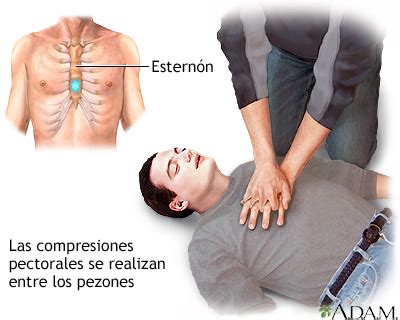 Esquema de las compresiones torácicas en RCP en un adulto