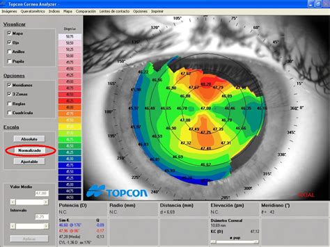 Ejemplo de mapa topográfico corneal con código de colores