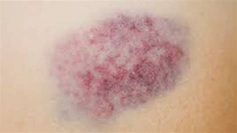 Piel de una persona mayor con equimosis en el antebrazo