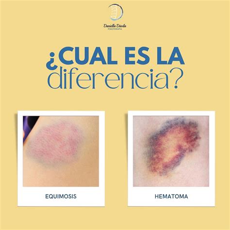 Ilustración comparativa de petequias y equimosis