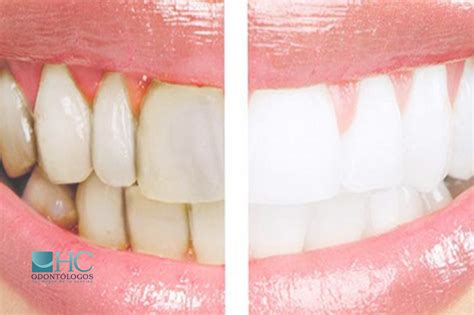 Esquema de una boca sana y una boca envejecida con problemas dentales