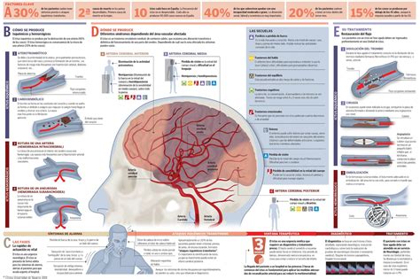 Diagrama de las áreas cerebrales afectadas por un accidente cerebrovascular en el hemisferio derecho