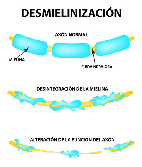 Esquema de las lesiones desmielinizantes en el sistema nervioso central