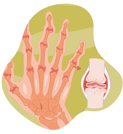 Ilustración de deformidades articulares en manos por artritis reumatoide