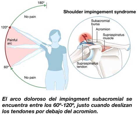esquema de pinzamiento subacromial
