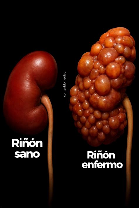 Esquema de un riñón sano vs. riñón con cambios por envejecimiento