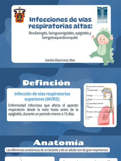 Diagrama de las vías respiratorias afectadas por la micrognatia en el síndrome de Treacher Collins