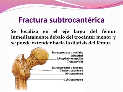 Esquema anatómico del fémur señalando las zonas de fractura: cabeza, cuello, intertrocantérica y subtrocantérica.