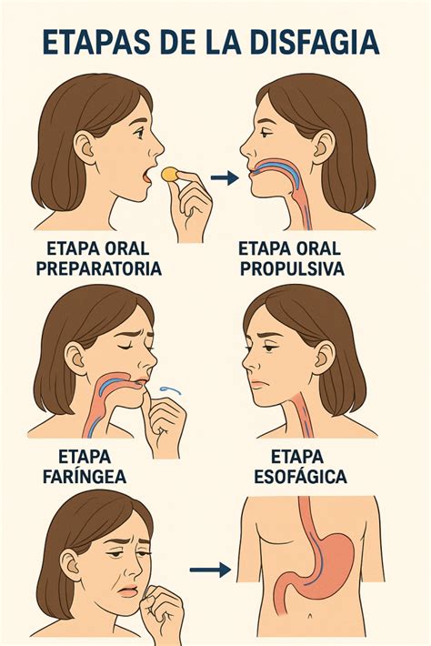 Infografía detallando el proceso de deglución y las áreas afectadas por la disfagia.