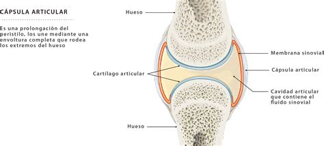 Diagrama mostrando la anatomía de una articulación sana y una con artrosis