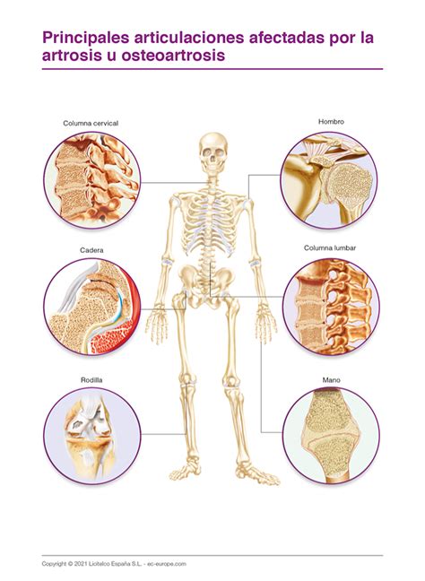 ilustración médica mostrando las articulaciones comúnmente afectadas por la artrosis (cadera, rodilla, manos, columna).