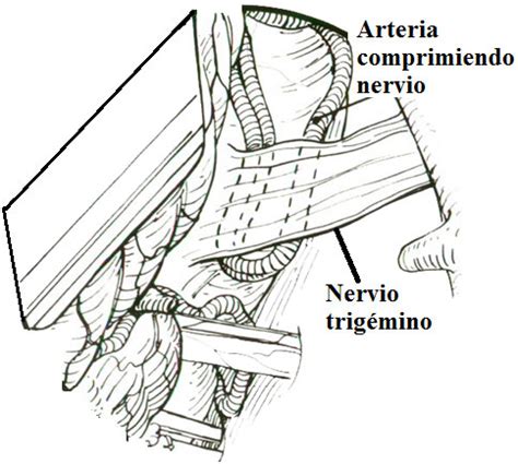 Ilustración de la compresión microvascular del nervio trigémino por un vaso sanguíneo.
