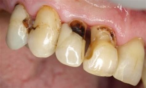 Esquema de un diente con caries radicular y retracción gingival