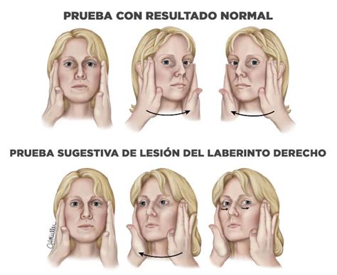 Diagrama: Representación de la maniobra de impulso cefálico y la detección de sacádicos correctivos.