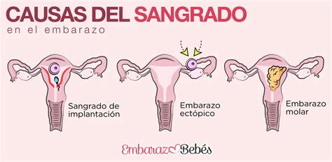Diagrama que ilustra el útero y las posibles causas de sangrado posmenopáusico.