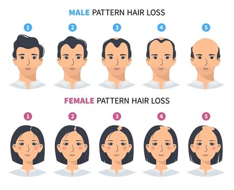 Infografía: Diferencias entre calvicie de patrón masculino y femenino