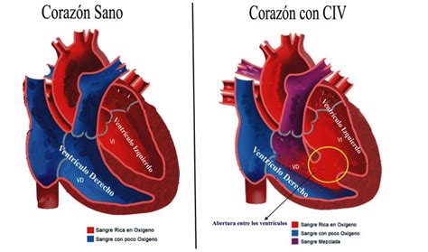 Esquema anatómico mostrando defectos cardíacos congénitos comunes (CIA, CIV, coartación de aorta)