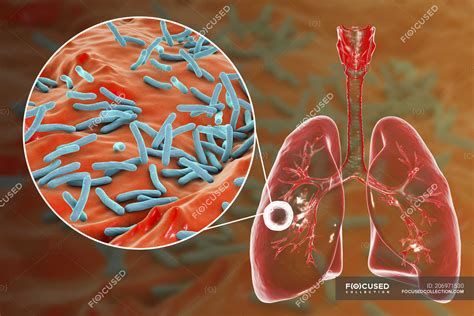 Esquema de la bacteria Mycobacterium tuberculosis infectando los pulmones