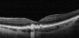 Imagen de OCT mostrando drusas maculares, indicativas de degeneración macular.