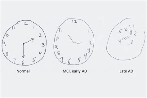 Ejemplo de un dibujo de reloj en el Test del Reloj para evaluación cognitiva