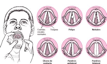 Representación de las cuerdas vocales y sus posibles afecciones