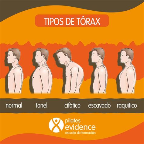 Ilustración de las diferentes formas de tórax y deformidades