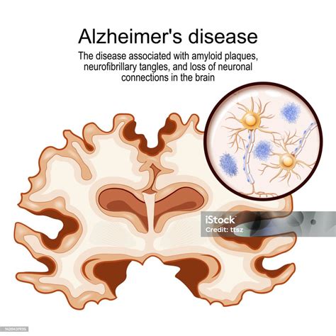 Micrografía electrónica mostrando placas amiloides en un cerebro con Alzheimer