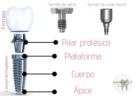 Diagrama de implante dental y su estructura