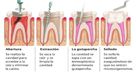 Esquema de un tratamiento de conducto dental