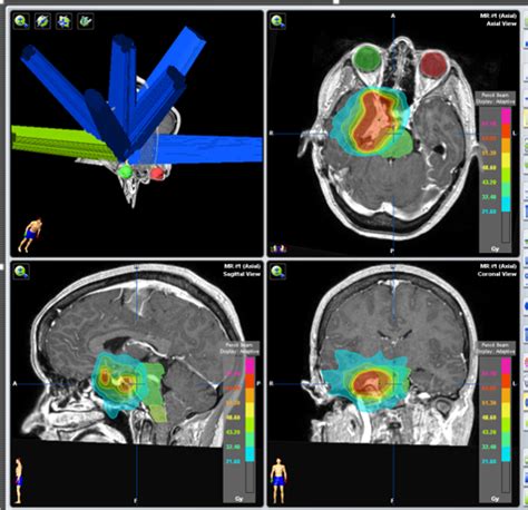 Esquema de planificación tridimensional para radioterapia en tumores cerebrales pediátricos.
