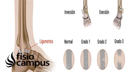 Infografía sobre los grados de esguince de ligamentos de rodilla