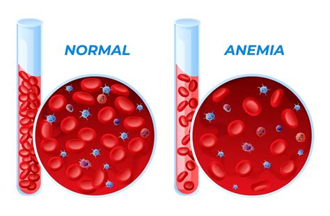 Gráfico: Impacto multifactorial de la anemia en la salud del adulto mayor
