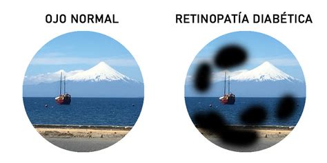 Infografía comparativa de los tratamientos con láser (focal vs. panretiniana) para retinopatía diabética