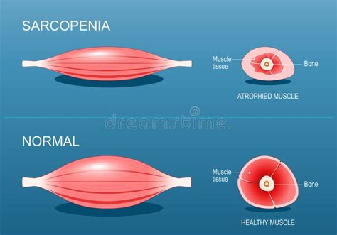 Ilustración de la degeneración muscular en la sarcopenia