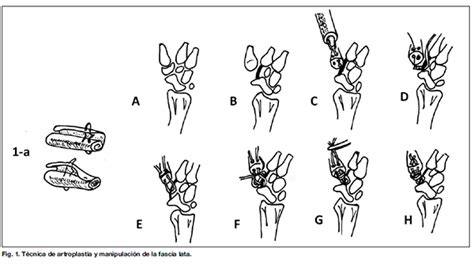 Diagrama de una artroplastia trapecio-metacarpiana con interposición de tendón