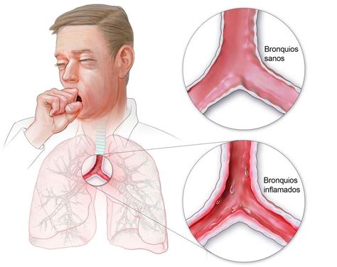 Esquema de las vías respiratorias inflamadas en la bronquitis