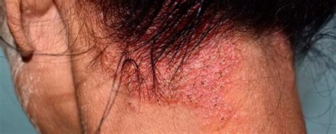 Ilustración de cuero cabelludo con dermatitis seborreica