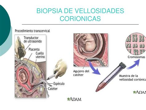Diagrama de amniocentesis y biopsia de vellosidades coriónicas.