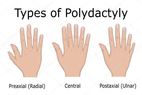 Infografía: Tipos de polidactilia (preaxial, central, postaxial)