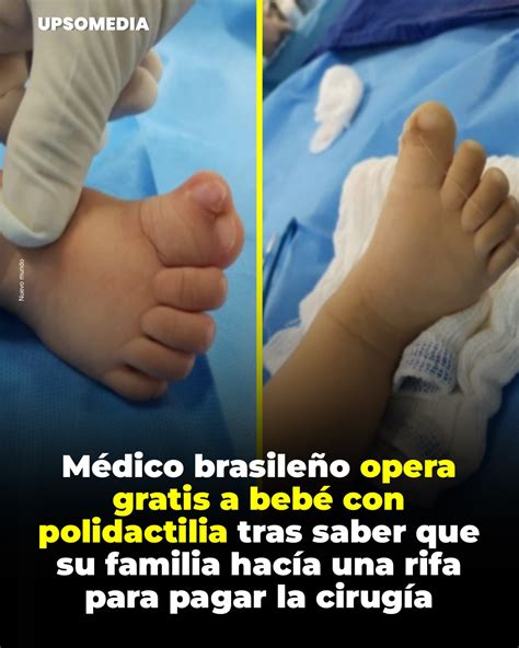 Foto: Mano de un bebé después de una cirugía de polidactilia