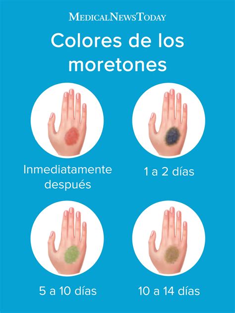 Infografía del proceso de curación de un moretón con sus cambios de color a lo largo del tiempo: de rojo/azul a morado/negro, luego verde y finalmente amarillo.