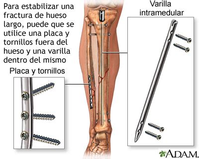 Imagen de una cadera con fijación interna mediante tornillos o placa con tornillos