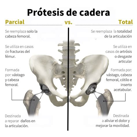Esquema de prótesis parcial y total de cadera