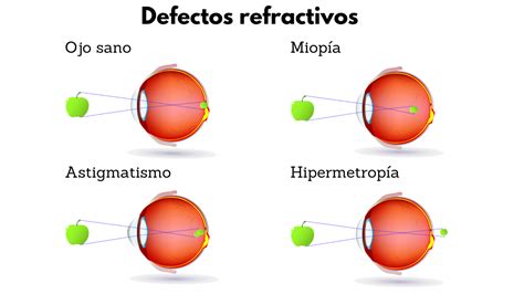 Ilustración esquemática de los errores refractivos: hipermetropía, miopía y astigmatismo.