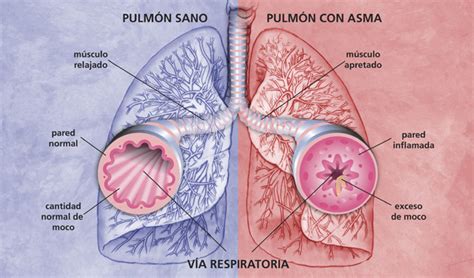 Diagrama de los pulmones afectados por asma, con bronquios inflamados.