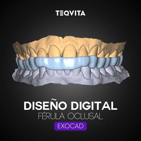 Imagen de una férula oclusal dental, mostrando su diseño para encajar en la mandíbula.