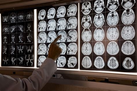 imagen de una resonancia magnética cerebral que muestra atrofia