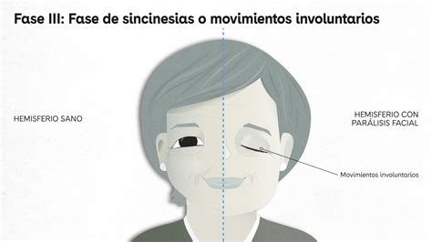 Infografía comparativa: Fases de la parálisis facial (hipotónica, reinervación y fase de secuelas o sincinesias).