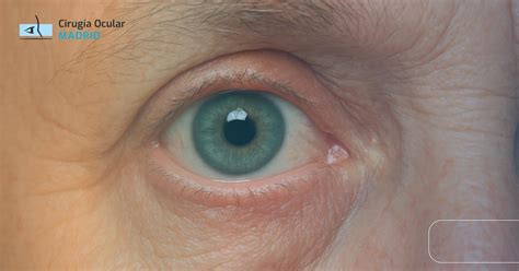 Ojo de un anciano mostrando el arco senil, con un fondo suavemente celeste